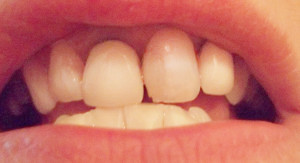 bleaching-nachher